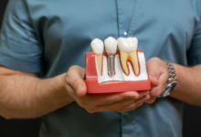 5 Benefits Of Combining Whitening With Implant Restorations