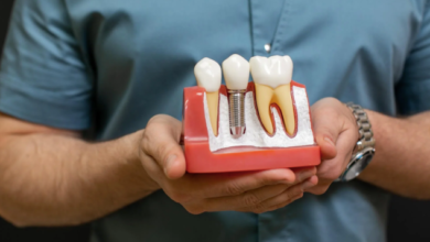 5 Benefits Of Combining Whitening With Implant Restorations